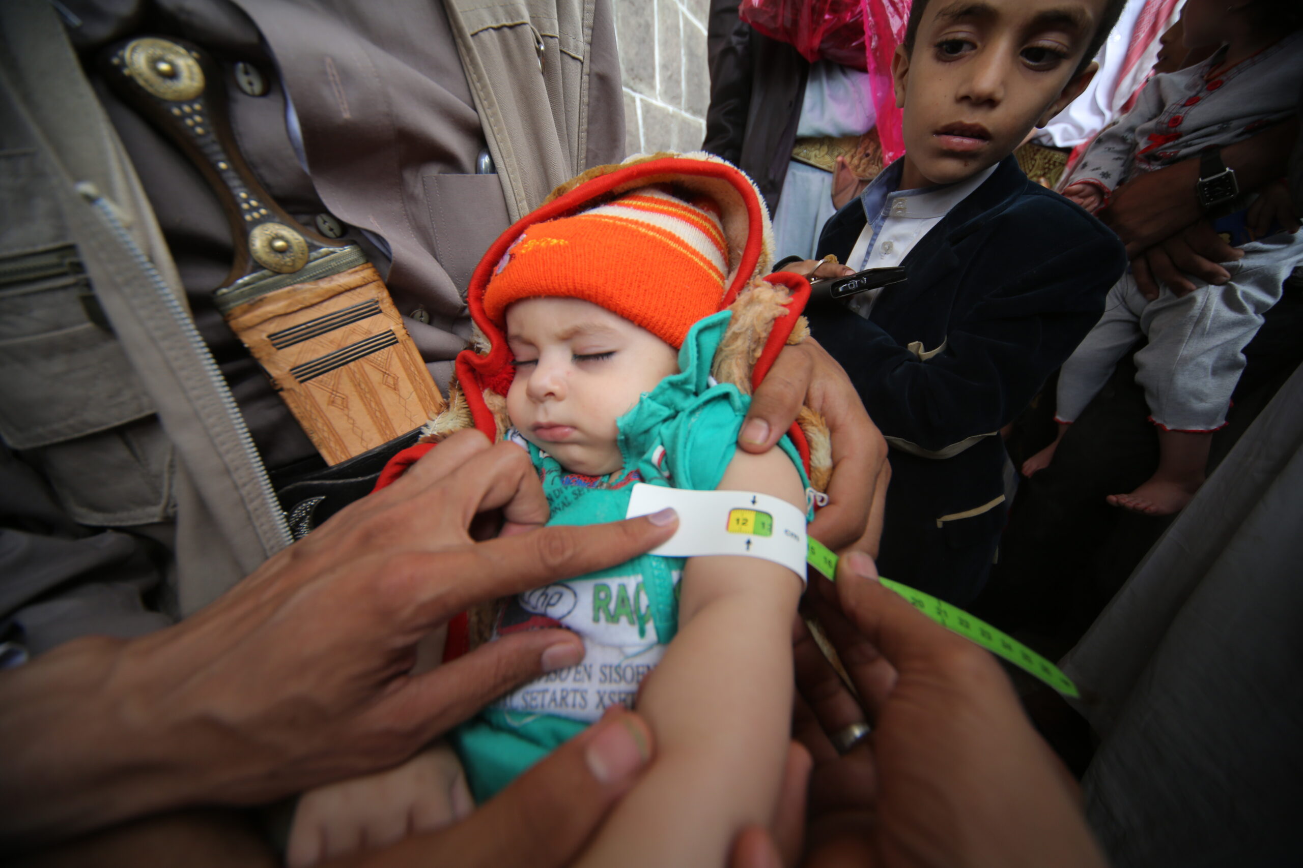 Yemen: Aid Cuts Lead to Surge in Malnutrition