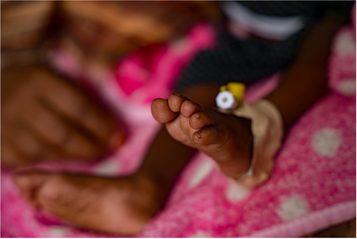 A child receiving treatment for severe acute malnutrition.